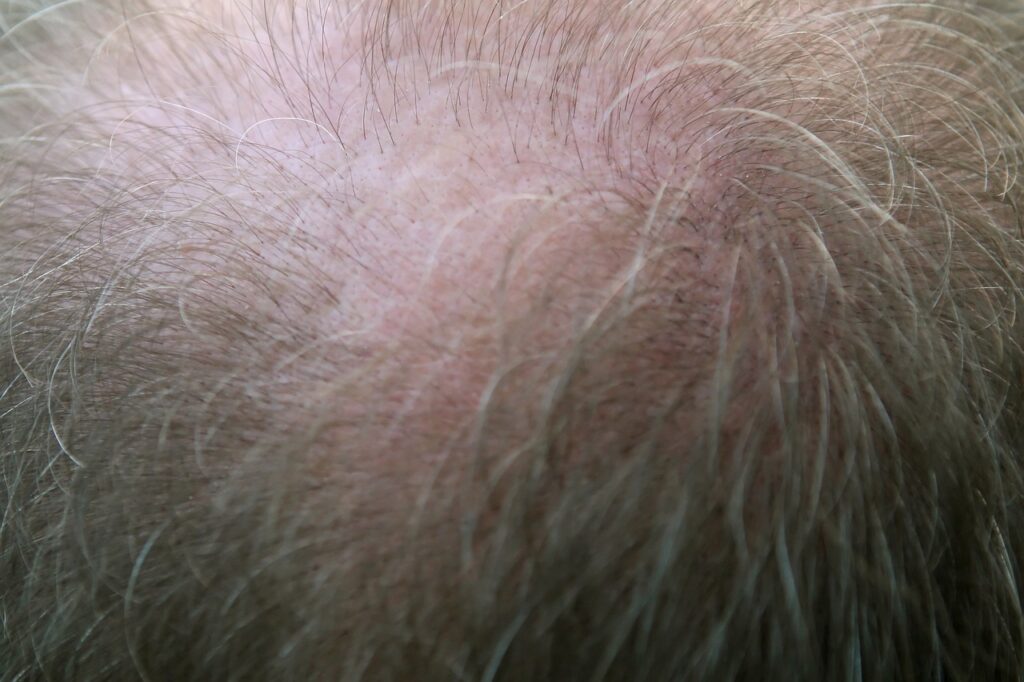 adult, bald, balding-1238997.jpg